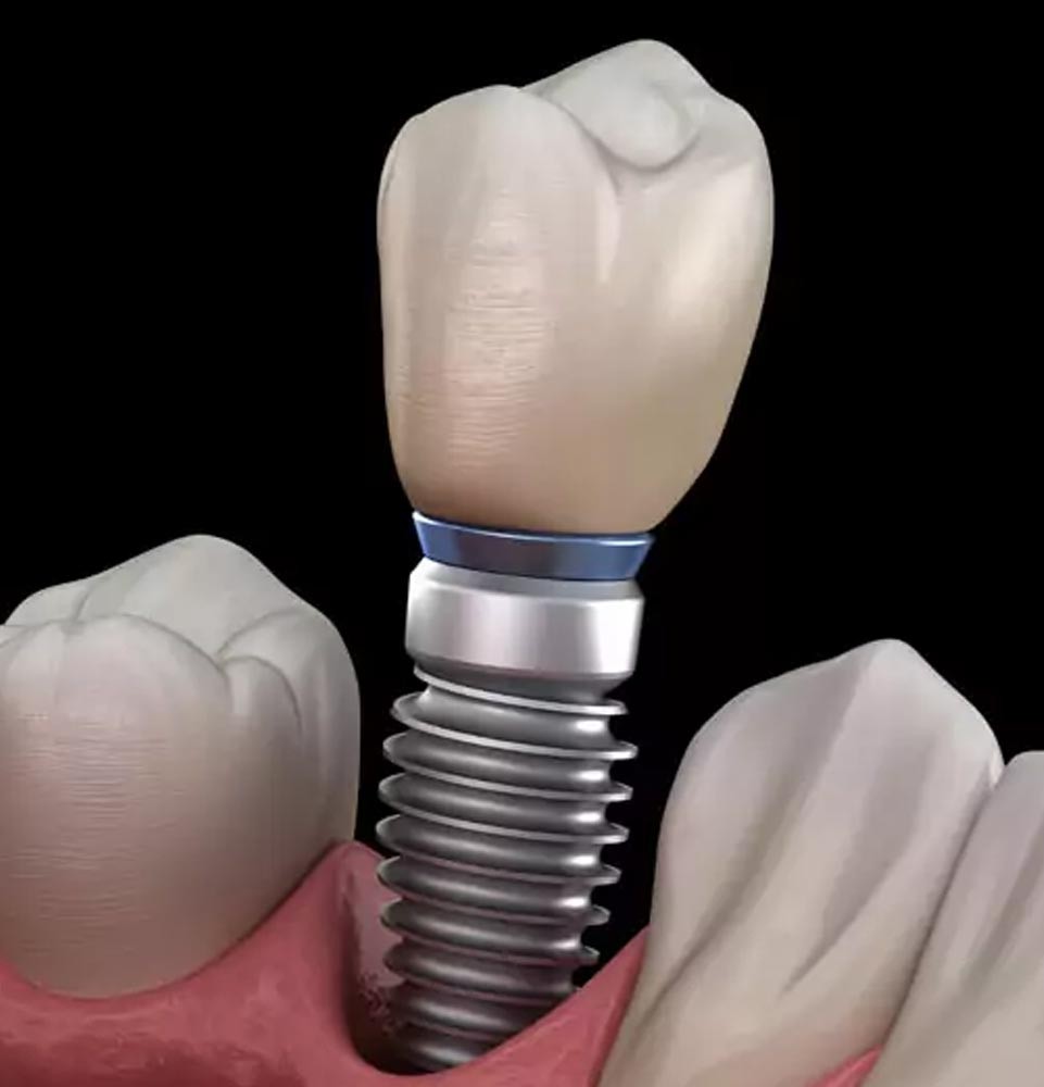 Dental implant illustration