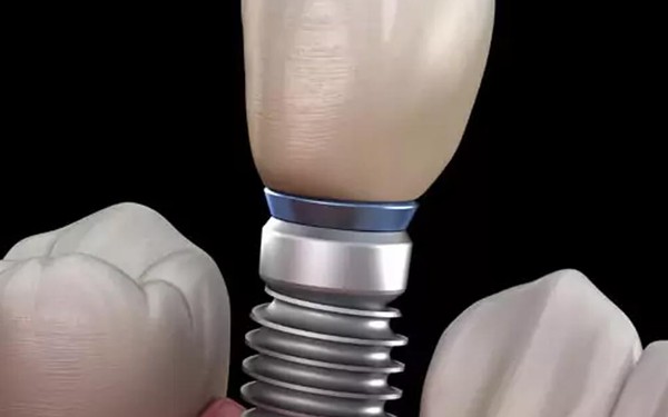 Dental Implants vs. Dentures - A Comprehensive Comparison for Your Smile Restoration Choices
