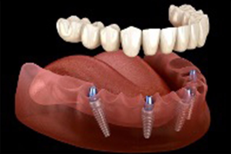all on x implants