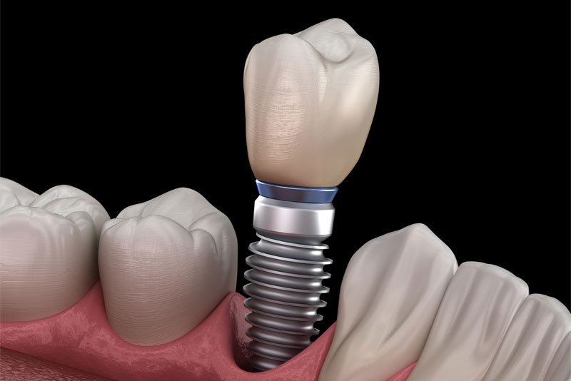 Dental implant illustration