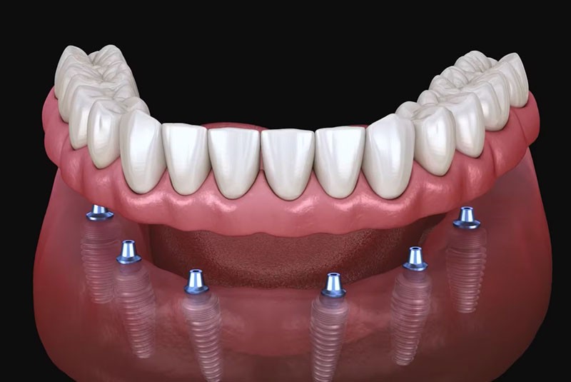 Dental implants illustration