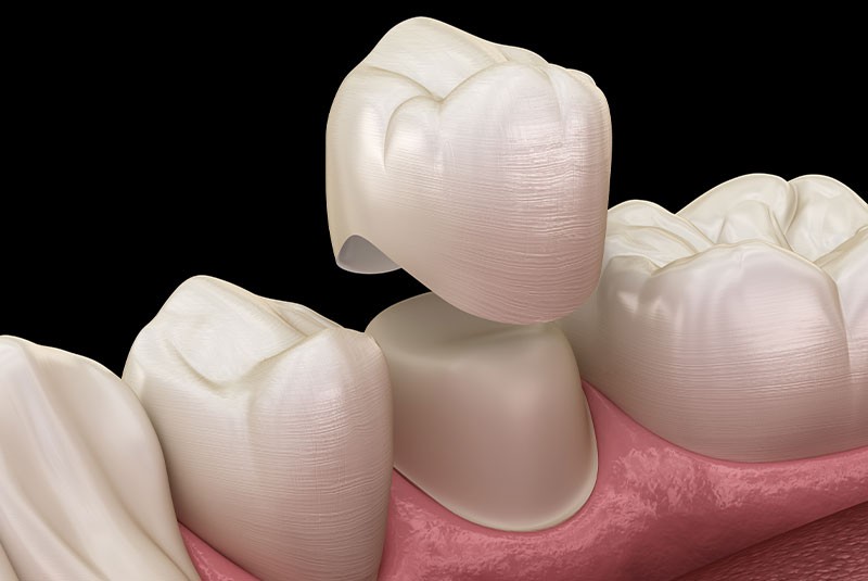 Dental crown illustration