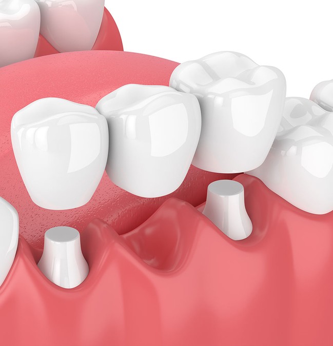 dental bridge