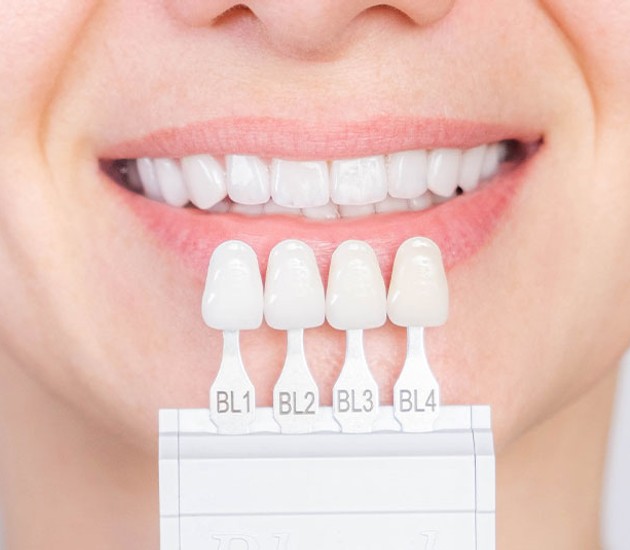 porcelain veneers