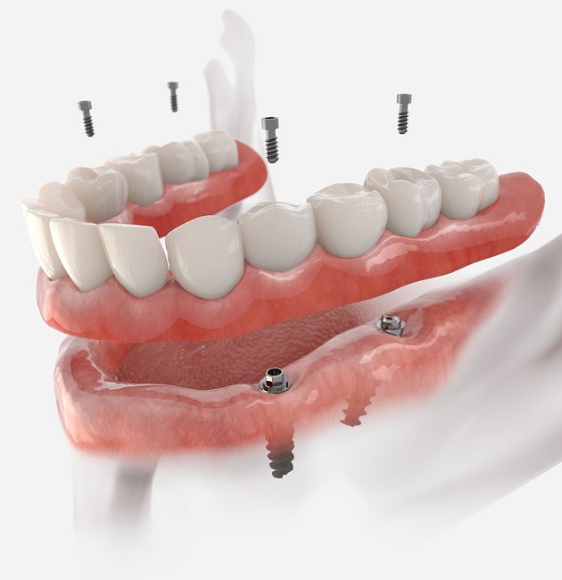 all on 4 dental implants