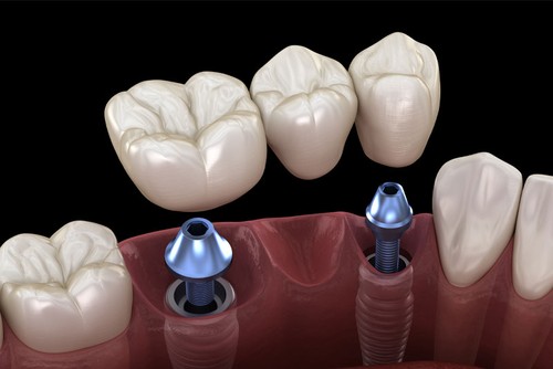 dental bridges