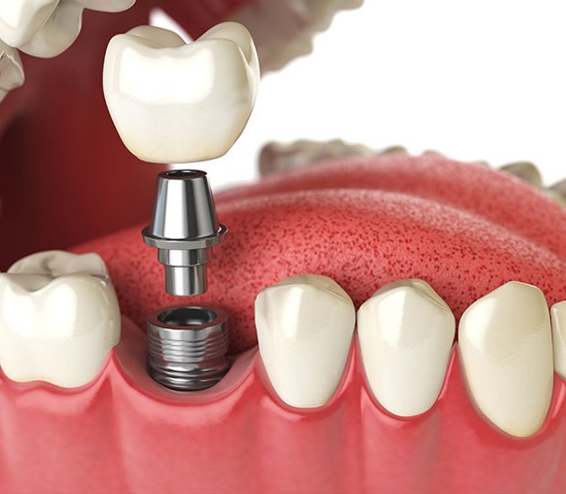 dental implant