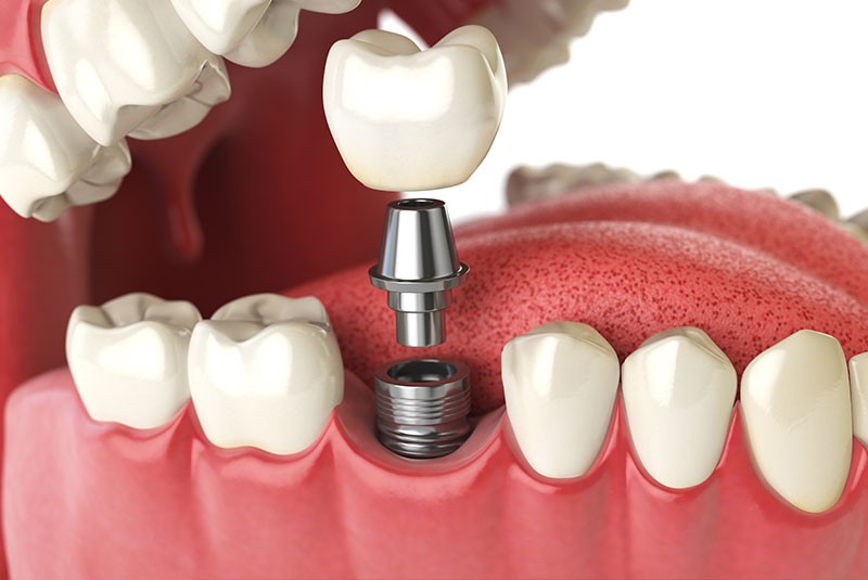 Dental implant illustration