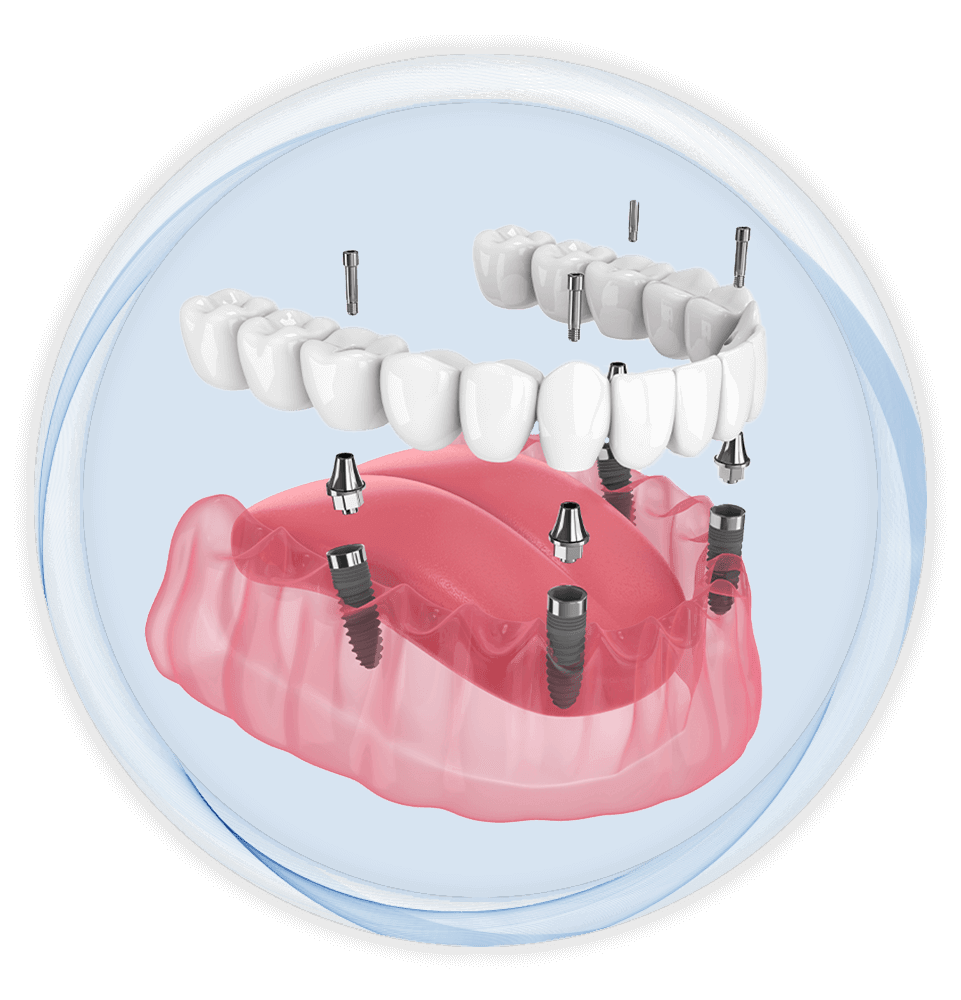 Dental implants illustration