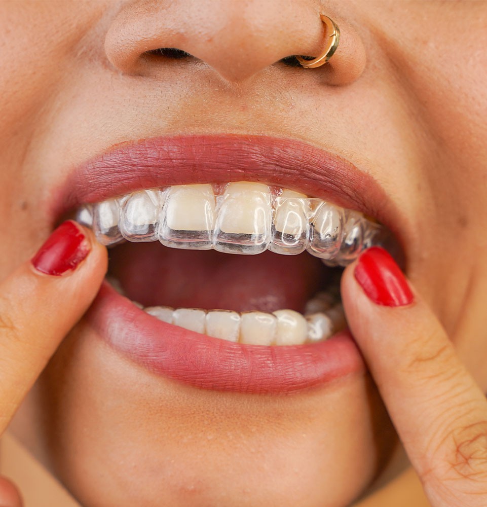 Person wearing Invisalign clear aligners