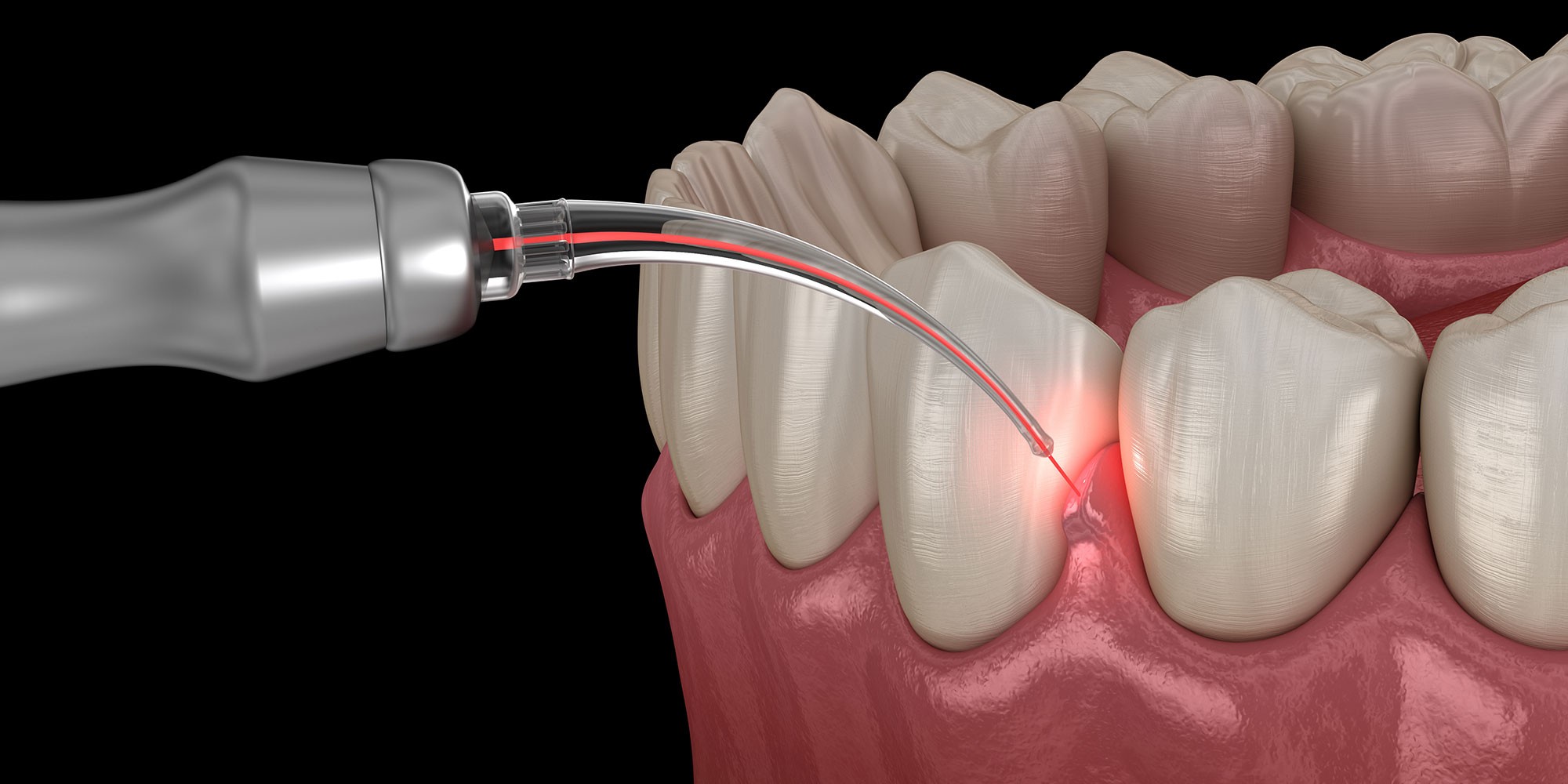 LANAP Laser Gum Treatment: What It Is and How It Treats Gum Disease