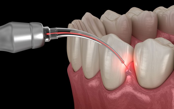 LANAP Laser Gum Treatment: What It Is and How It Treats Gum Disease