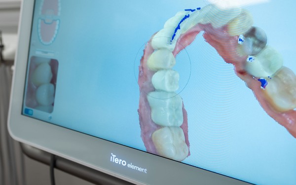 Discover the Future of Smiles with Dental Implants Revolutionizing Oral Health
