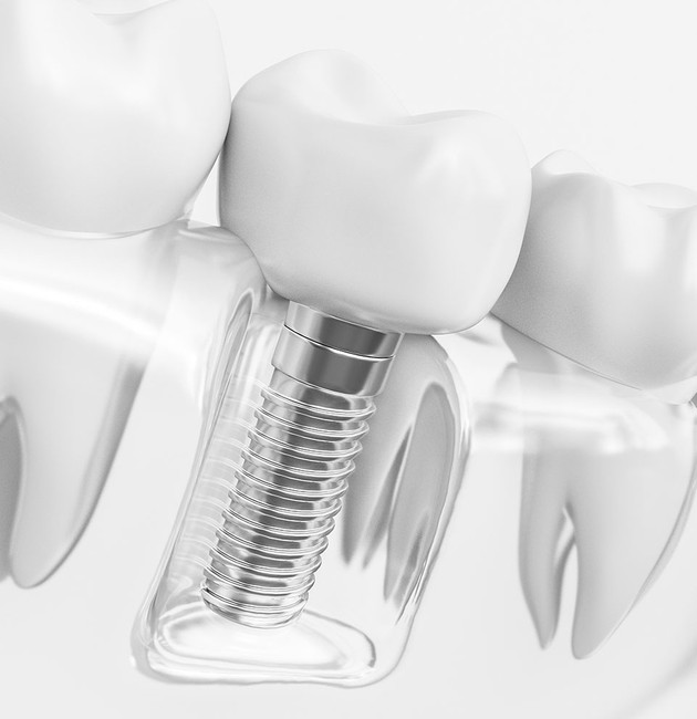 dental implant